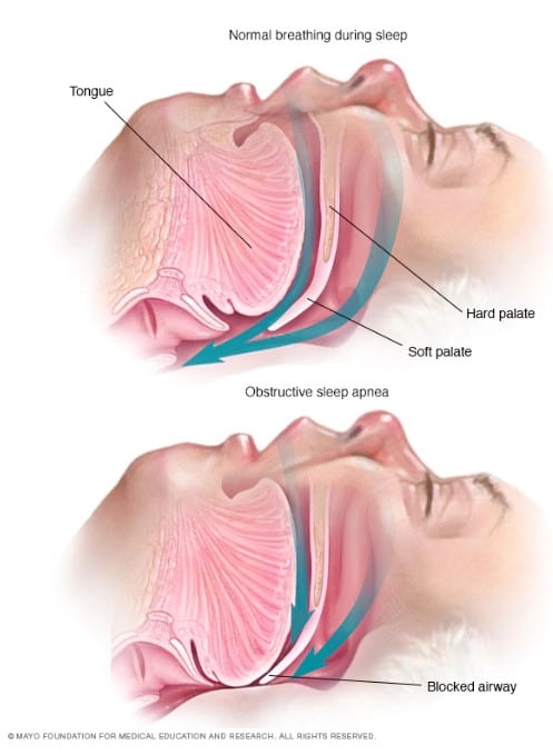 Obstructive sleep apnea นอนกรน หยุดหายใจ